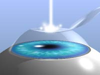 LASIK